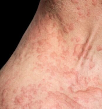 Bacterial-Infections-1