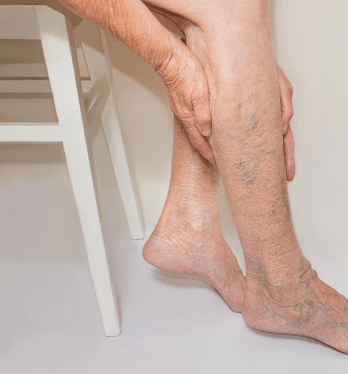 Can-Varicose-Veins-be-Cured-1
